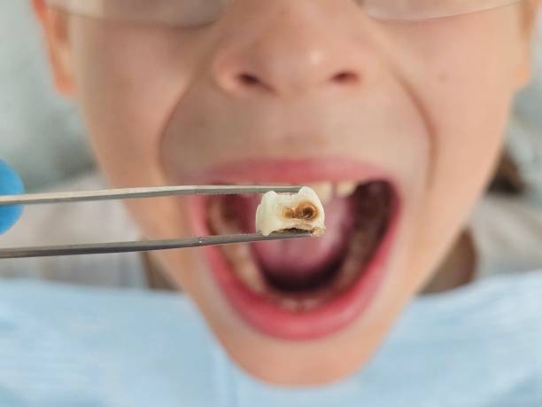 Best Root Canal Emergency Dentist  in Sunnyside, GA